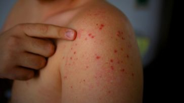 odra choroba objawy zdjęcia