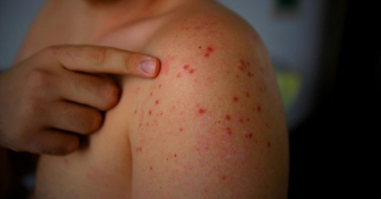 odra choroba objawy zdjęcia