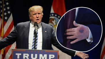 trump siniaki na rękach