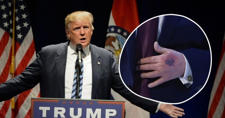 trump siniaki na rękach