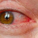 dysfunkcja gruczołów meiboma forum