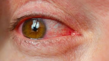 dysfunkcja gruczołów meiboma forum