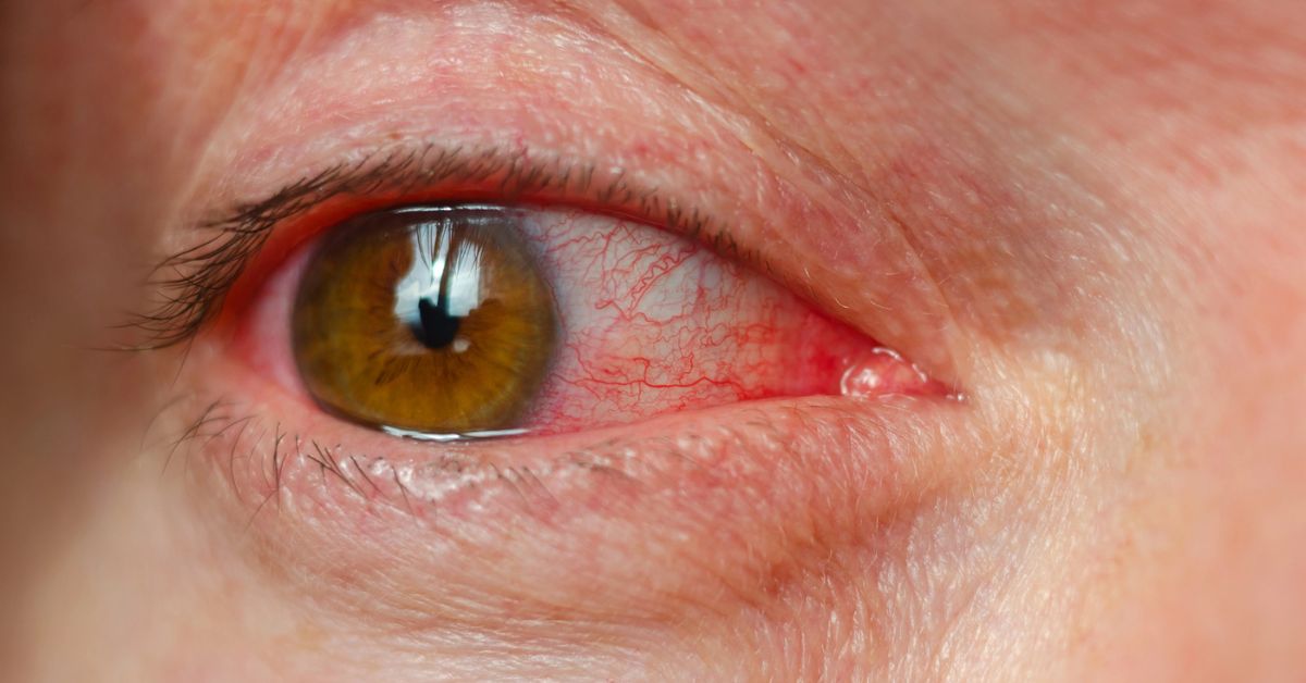 Dysfunkcja gruczołów Meiboma. Przyczyny, objawy i leczenie. Jak sobie poradzić?